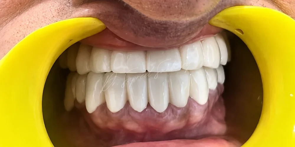 Frontal retracted intraoral photograph showing completed full-mouth fixed restorations